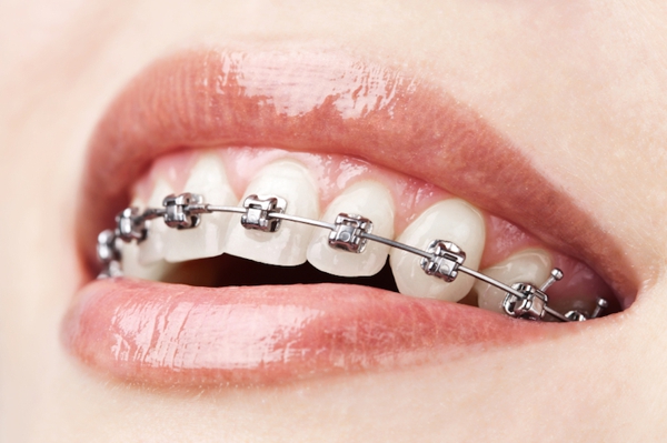 Brackets Metálicos