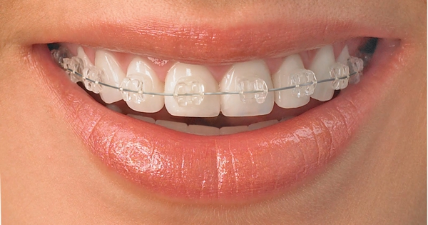 Brackets estéticos transparentes