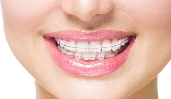 Brackets estéticos blancos (de cerámica)